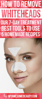 Moreover, avoid oily and spicy food, alcohol, carbonated drinks, chocolates, and coffee as they give way to whiteheads. How To Get Rid Of Whiteheads Fast And Safely On Face 7 Day Treatment