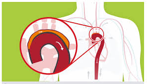 As the name suggests, this type happens in your aorta. Types Of Aneurysms American Heart Association