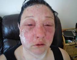 Like other forms of contact dermatitis repeated exposure may cause the allergy to. Horror Hair Dye Allergic Reaction Leaves Woman S Life In Tatters Express Co Uk