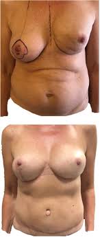 Single-stage buried autologous breast reconstruction (BABR) - Journal of  Plastic, Reconstructive & Aesthetic Surgery