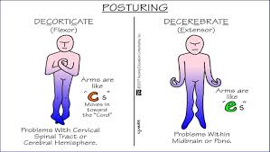 Posturing 15086b9473354d2464c Jpg 1379 778 Medical Surgical Nursing Surgical Nursing Nursing Mnemonics