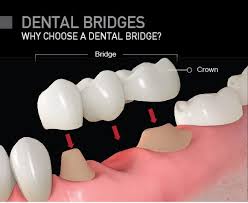 When do you need dental bridge repair? Dental Bridges Dental Bridges White Hills Dental Bridges Treatment Cost Whitehills Dental Practice Bendigo Dentists Dental Clinic Bendigo Dentist In Bendigo
