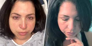 Woman's Eye Freckle Turns Into Ocular Melanoma Eye Cancer Tumor