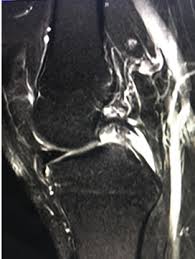 Image result for PCL Sag Test