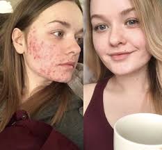 There may be a firm, rounded reddish bump on the surface but the bump can also. What Is Cystic Acne What Are The Treatments