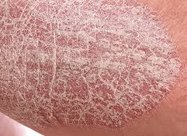 Image result for psoriasis