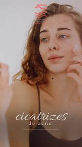 Caso clínico de CICATRIZES DE ACNE 🤩 RESULTADO NO FINAL DO VÍDEO