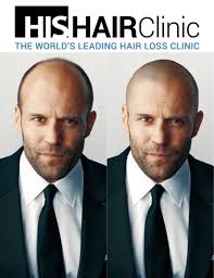 Fortunately, some pictures and videos of jason statham with hair are still available on the internet. His Hair Clinic On Twitter How Would Jason Statham Look With Smp Https T Co Kl5sfmrajl