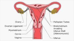 Studies using ultrasound or mri certainly support. Adenomyosis Symptoms Diagnosis Treatments Everyday Health