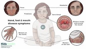 Image result for Hand foot and mouth disease HFMD roof of mouth