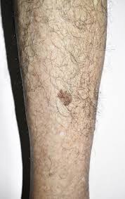 Image result for liver spots on legs