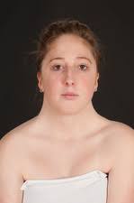 Image result for Webbed Neck