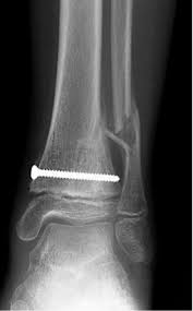 Image result for Growth Plate