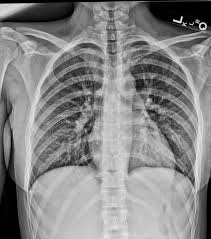 Atelectasis symptoms include possible chest pain or pressure, cough, and difficulty breathing. Ai Embedded X Ray System Could Help Speed Up Detection Of A Collapsed Lung Ge Healthcare United States