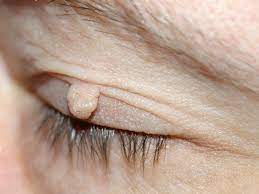 What are the symptoms of fibroids? Fibroma Wikipedia