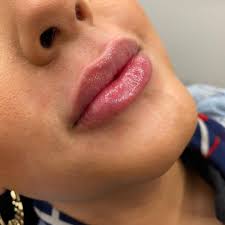 Discover the transformative power of chin and jawline filler