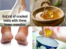 This helps remove the dry, flaky skin on your heels. 9 Highly Effective Cracked Heels Home Remedy Verified