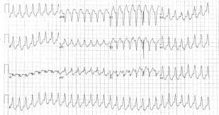 An important rhythm distinction between ventricular (vt) or supraventricular (svt with aberrancy) this will influence your patient management. An Approach To Diagnosing Supraventricular Tachycardias On The 12 Lead Ec Intechopen