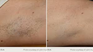 Coolglide Laser Hair Removal Lakes Dermatology