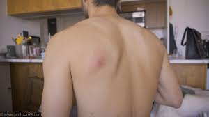 Their appearance signals the beginning of a new. Phil Torres On Twitter You Asked For It Here S My Bot Fly Larva Growing In My Back Probably Around 12 Days Old At This Point If You Look Closely You Ll See Two