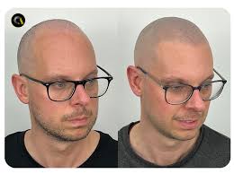 Nuestros resultados de micropigmentación capilar