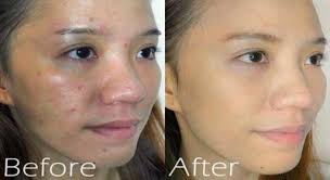 Before And After Acne Face Mask Cleansingmaskpores Acnescarsovernight Best Acne Face Masks Face Acne Acne Face Mask