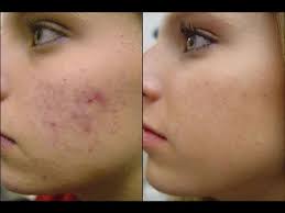 Como Eliminar El Acne Granos Espinillas Y Puntos Negros Youtube