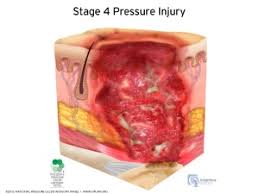 Pressure Ulcers Physiopedia