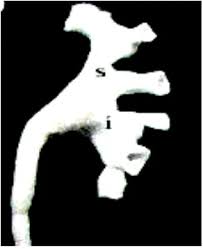 We did not find results for: Variations In The Pelvicalyceal Pattern In Human Kidneys