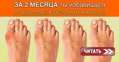 как лечить косточку на ноге в домашних условиях отзывы Ty Znaesh Ot Chego Poyavlyaetsya Tak Nazyvaemaya Kostochka Valgusnaya Deformaciya Palca Stopy Tesnaya Obuv Pit Natural Remedies Get Rid Of Bunions Foot Health
