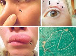 Depending on the size and location of the lump under the jaw or mandible you could be feeling a salivary gland or lymph node. A Weird Lump On A Woman S Face Turned Out To Be A Worm Crawling Under Her Skin Live Science