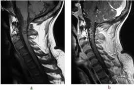 Although no abnormalities were observed on brain and spinal magnetic resonance imaging and electroencephalography, peripheral nerve conduction velocity tests failed to evoke motor and sensory nerve action potentials. Https Ispub Com Ijra 5 2 11881