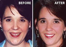 How to solve a gummy smile. Gummy Smiles What Causes A Gummy Smile