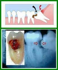Tearful Wisdom Teeth What To Expect Dentistday Wisdomteethgrowingin Dental Tooth Caries Wisdom Teeth