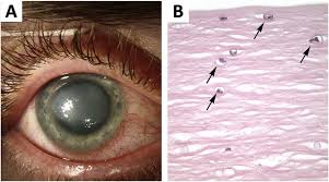 Image result for Ciliary Flush