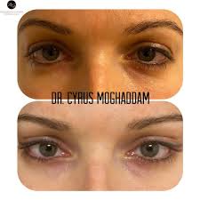 Fox valley ophthalmology located in st. Cat Eye Lift Fox Eye Bella Eyes Moghaddam Groos
