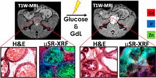 Hearing the doctor tell you that you've got cancer is undoubtedly one of the worst things you may experience. Synchrotron Radiation X Ray Fluorescence Elemental Mapping In Healthy Versus Malignant Prostate Tissues Provides New Insights Into The Glucose Stimulated Zinc Trafficking In The Prostate As Discovered By Mri Inorganic Chemistry X Mol