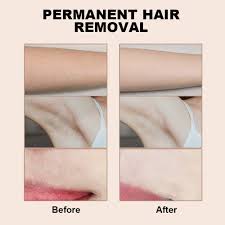 It can be done on other parts of the body too, like the armpits. Buy Aohekang Ipl Hair Removal Device With Fda Certification Of Us Safest Laser Hair Removal Facial Hair Removal For Women With 999900 Flashes At Home Permanent Hair Removal For Face Lip Armpit