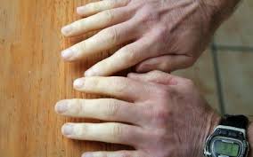 Anfallsweise auftretende minderdurchblutung der finger, seltener auch der zehen, durch eine vorübergehende, krampfartige verengung der gefäße (gefäßspasmus); Raynaud Syndrom Ursachen Symptome Therapie Onmeda De