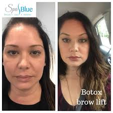 Check spelling or type a new query. Spa Blue Before And After A Botox Brow Lift Botox And Facebook