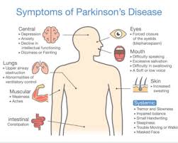 Parkinson disease is most common in people who are older than 50. A Grandmother S Diagnosis With Parkinson S Disease Aihc
