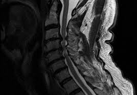 Your health care practitioner may request this scan if pain hasn't improved with basic treatment or if the pain is accompanied by numbness or . Cervical Myelopathy Discoveries Paving The Way To Better Care Mayo Clinic