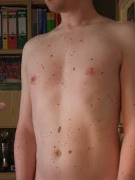 Hast du schon den befund vom hautarzt bekommen? Bauch Ok Oder Sind Das Zu Viele Muttermale Krankheit Haut Tattoo