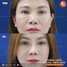 Giảm nếp nhăn rãnh cười bằng phẫu thuật Nâng nền mũi