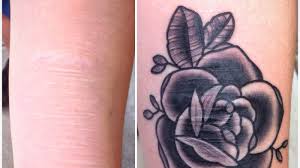 Microart™ scar treatment camouflages scars by utilizing proprietary technology to cover the scars with a skin color makeup that last years on the microart semi permanent makeup is an extremely effective scar treatment. Effects Of Toledo Tattoo Artist S Work Are More Than Skin Deep Npr