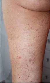 Fortunately, the bumps will disappear within a day or two after your treatment. A Discussion On Hair Growth And Diode Laser Hair Removal