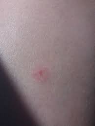 I choćby dlatego na pytanie „czy komary przenoszą boreliozę? nie da się jednoznacznie odpowiedzieć. Czy To Borelioza Nie Udziabal Mnie Zaden Kleszcz Theia Wykop Pl