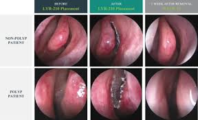 The polyps can develop at different sites in the. 424b4