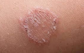 It has to sit for 10 minutes before you rinse it off. 5 Effective Ways To Cure Ringworm Naturally