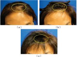 Jul 25, 2020 · red light therapy reduces hair loss and improves hair growth. Stem Cell Therapy For Hair Loss Irvine Oc Hair Restoration